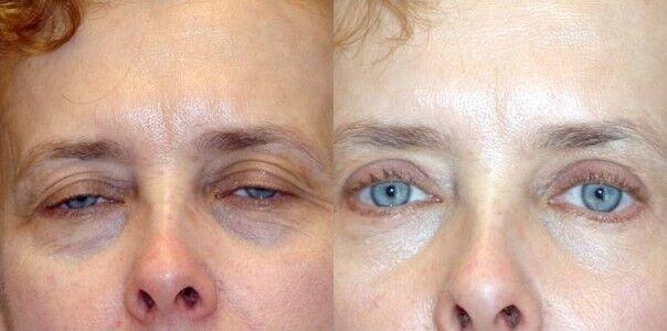 Blepharoplasty result at Winslow Facial Plastic Surgery: Catherine Winslow MD in Carmel, IN