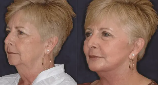 Facelift result at Winslow Facial Plastic Surgery: Catherine Winslow MD in Carmel, IN