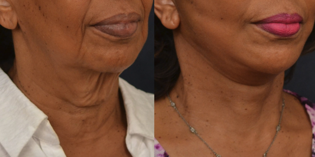 Deep Plane Facelift result at Winslow Facial Plastic Surgery: Catherine Winslow MD in Carmel, IN