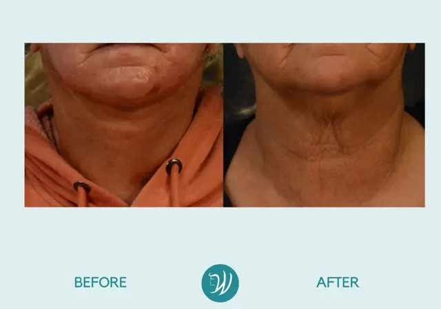 Neck Lift result at Winslow Facial Plastic Surgery: Catherine Winslow MD in Carmel, IN