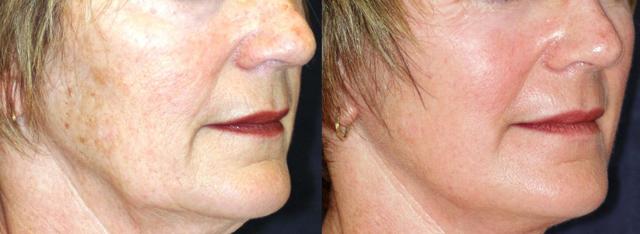 Chemical Peel result at Winslow Facial Plastic Surgery: Catherine Winslow MD in Carmel, IN