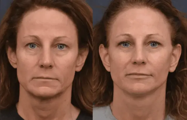 Deep Plane Facelift result at Winslow Facial Plastic Surgery: Catherine Winslow MD in Carmel, IN