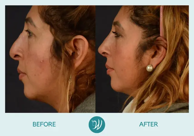 Rhinoplasty result at Winslow Facial Plastic Surgery: Catherine Winslow MD in Carmel, IN