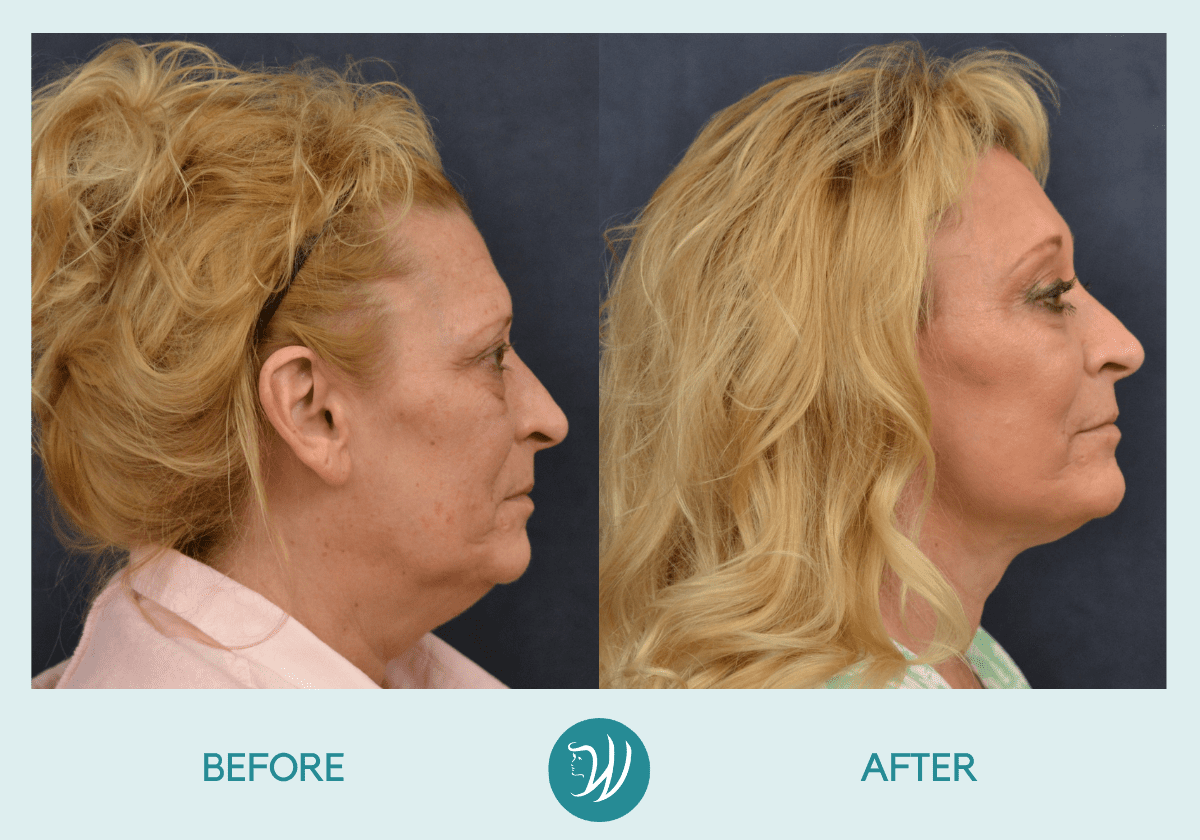 Winslow Facial Plastic Surgery: Catherine Winslow MD facelift result — Carmel, IN