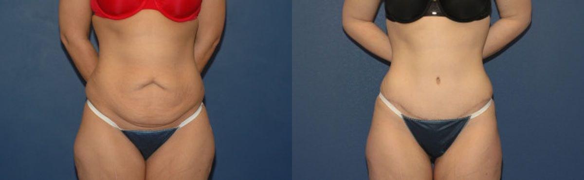 Sound Plastic Surgery tummy tuck result — Seattle, WA