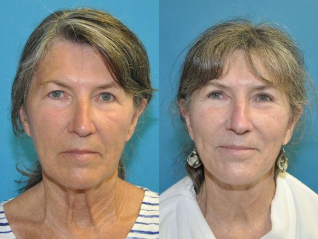 Deep Plane Facelift result at Sound Plastic Surgery in Seattle, WA