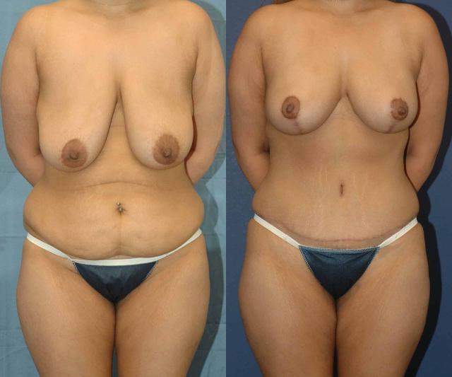 Mommy Makeover result at Sound Plastic Surgery in Seattle, WA