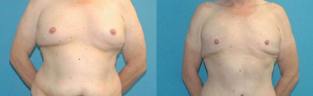 Liposuction result at Sound Plastic Surgery in Seattle, WA