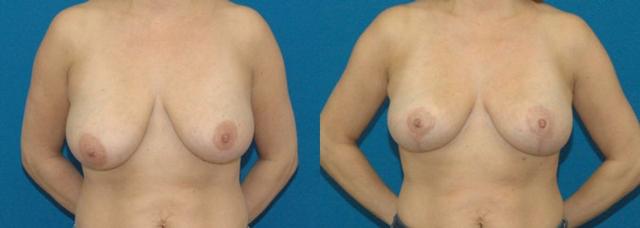 Breast Lift result at Sound Plastic Surgery in Seattle, WA