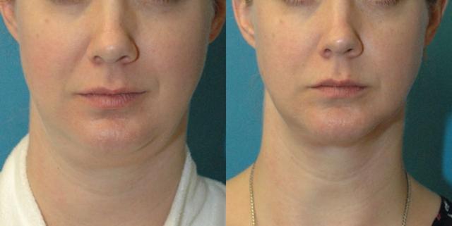 Neck Liposuction result at Sound Plastic Surgery in Seattle, WA