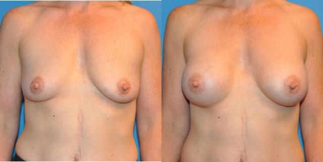 Breast Augmentation result at Sound Plastic Surgery in Seattle, WA