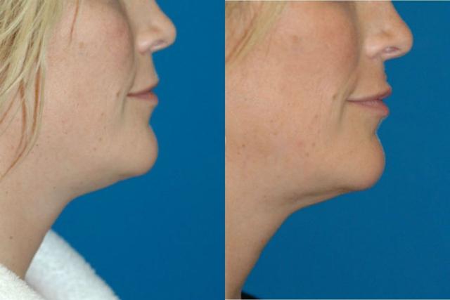 Neck Liposuction result at Sound Plastic Surgery in Seattle, WA