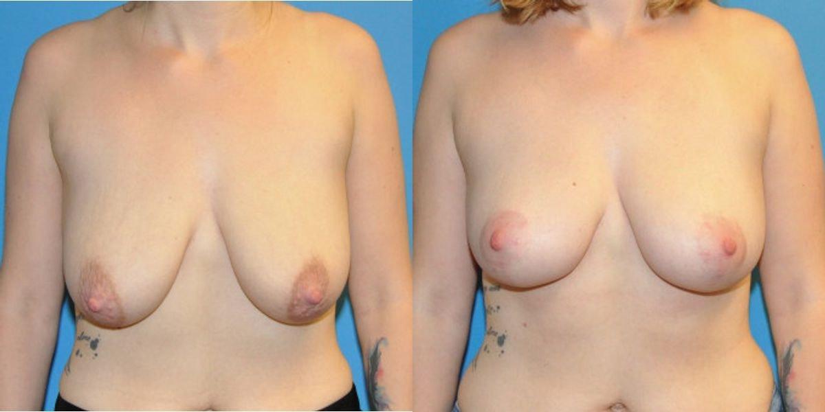 Sound Plastic Surgery breast lift result — Seattle, WA