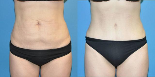 Mini Tummy Tuck result at Sound Plastic Surgery in Seattle, WA