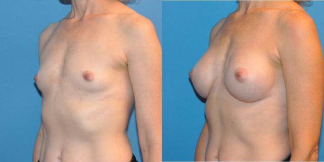 Breast Augmentation result at Sound Plastic Surgery in Seattle, WA