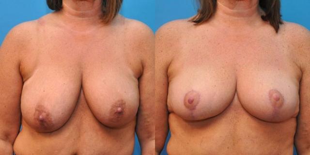 Breast Lift result at Sound Plastic Surgery in Seattle, WA