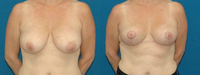 Breast Lift result at Sound Plastic Surgery in Seattle, WA