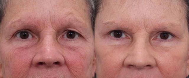 Blepharoplasty result at Sound Plastic Surgery in Seattle, WA