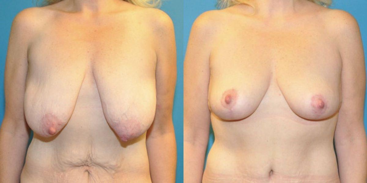 Sound Plastic Surgery breast lift result — Seattle, WA