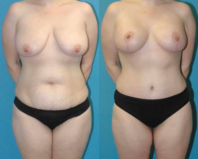 Mommy Makeover result at Sound Plastic Surgery in Seattle, WA