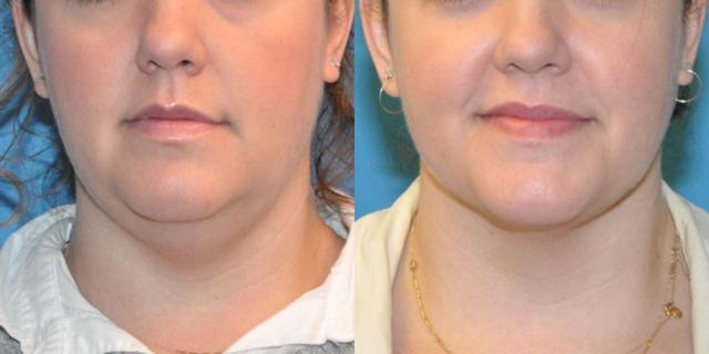 Neck Liposuction result at Sound Plastic Surgery in Seattle, WA