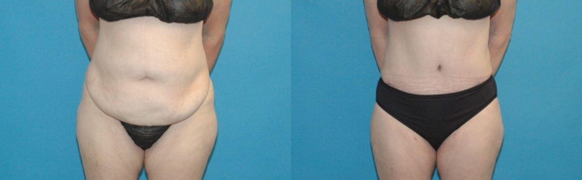 Sound Plastic Surgery tummy tuck result — Seattle, WA