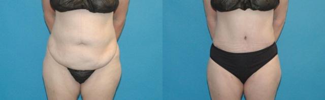 Mini Tummy Tuck result at Sound Plastic Surgery in Seattle, WA