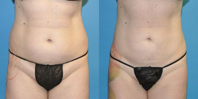 Liposuction result at Sound Plastic Surgery in Seattle, WA