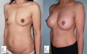 Alan T. Tran, MD breast augmentation result — Fountain Valley, CA