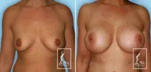 Alan T. Tran, MD breast augmentation result — Fountain Valley, CA