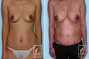 Alan T. Tran, MD breast augmentation result — Fountain Valley, CA