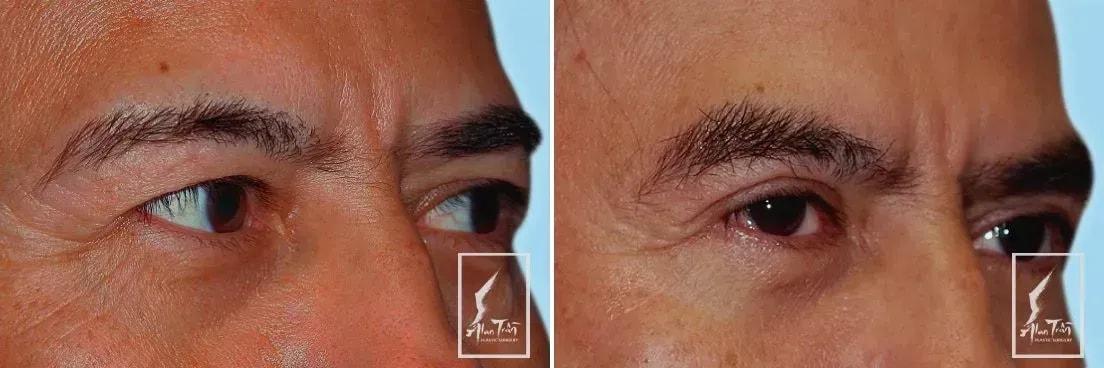 Alan T. Tran, MD eyelid lift result — Fountain Valley, CA