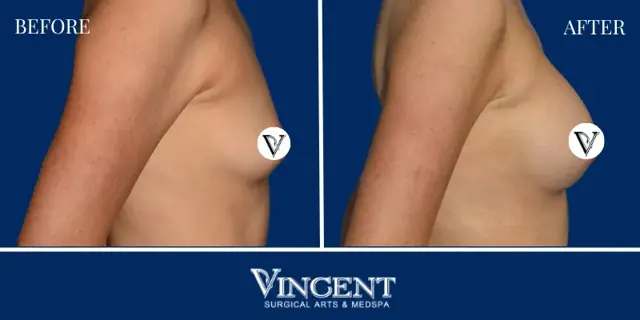 Breast Augmentation result at Vincent Surgical Arts in Cottonwood Heights, UT