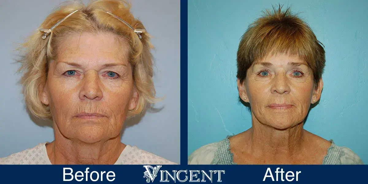 Vincent Surgical Arts brow lift result — Cottonwood Heights, UT