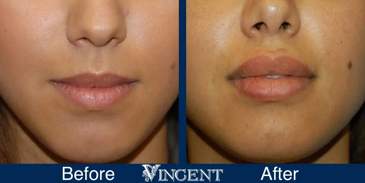Vincent Surgical Arts lip filler result — Cottonwood Heights, UT