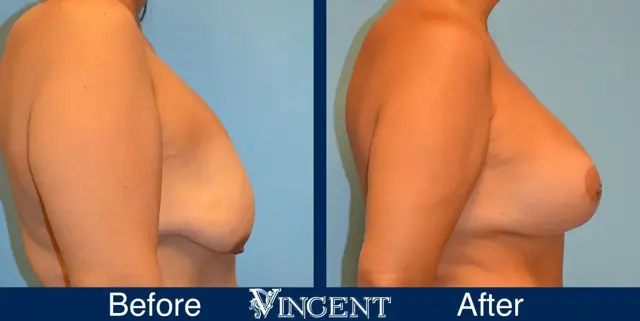 Breast Lift result at Vincent Surgical Arts in Cottonwood Heights, UT