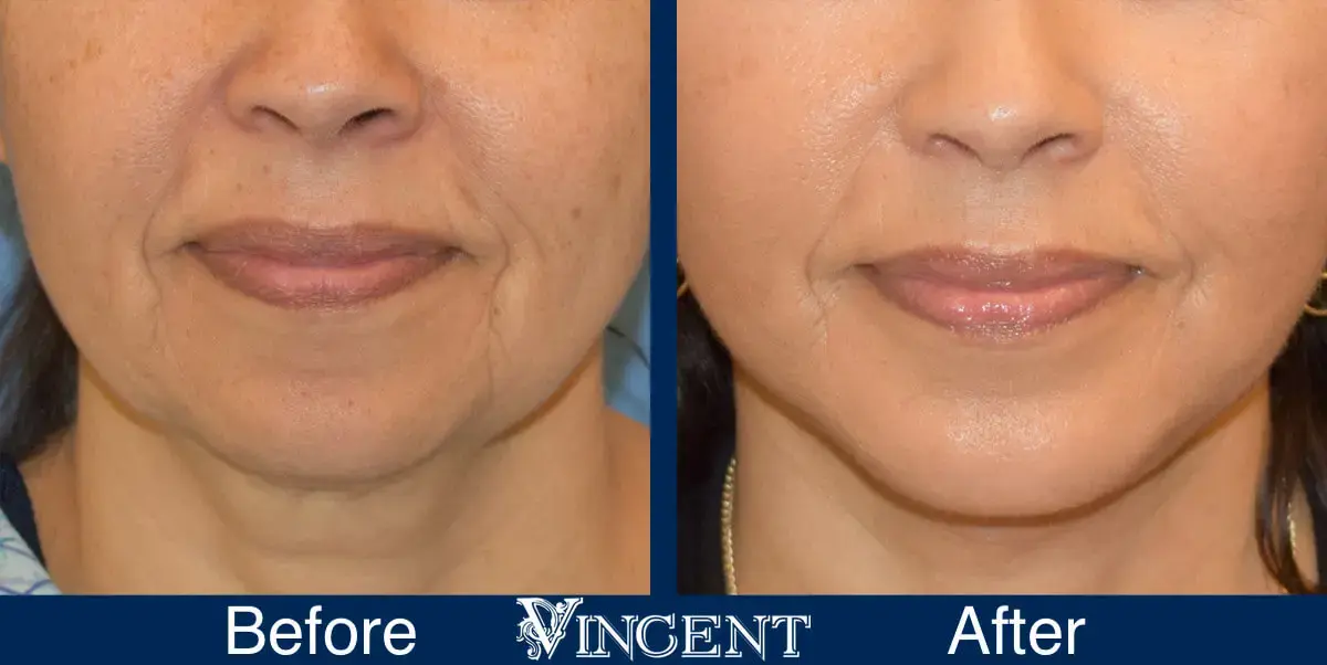 Vincent Surgical Arts chin implant result — Cottonwood Heights, UT
