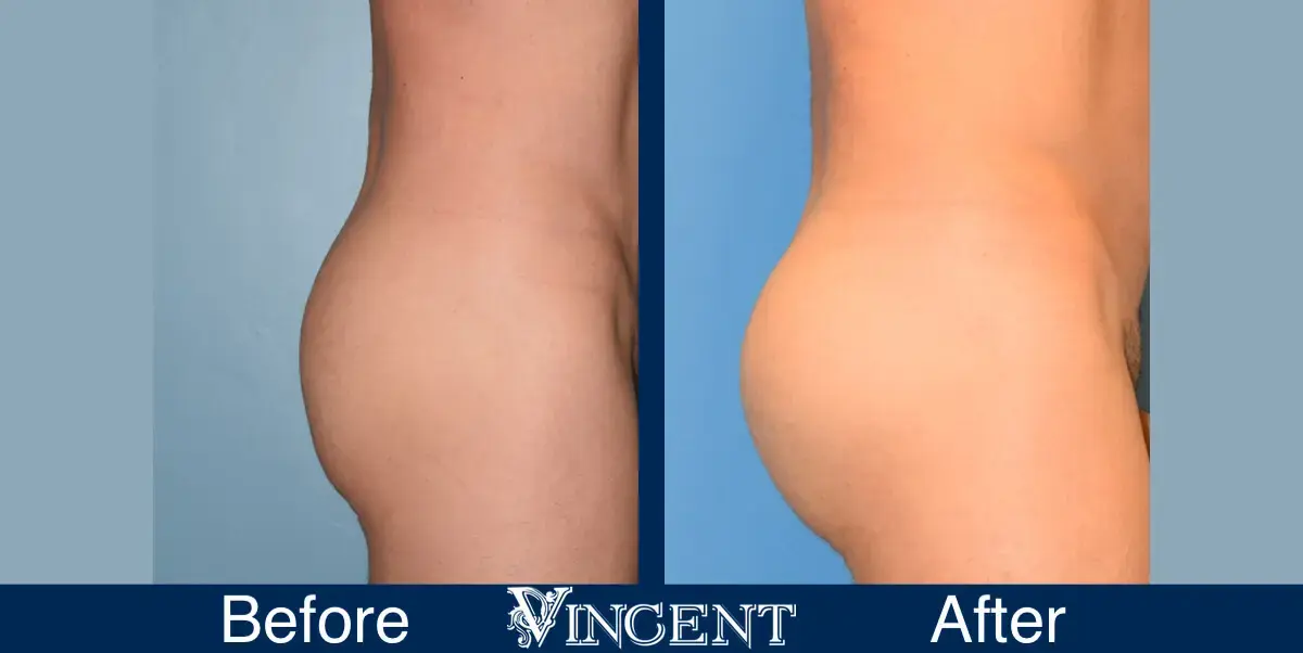 Vincent Surgical Arts bbl result — Cottonwood Heights, UT