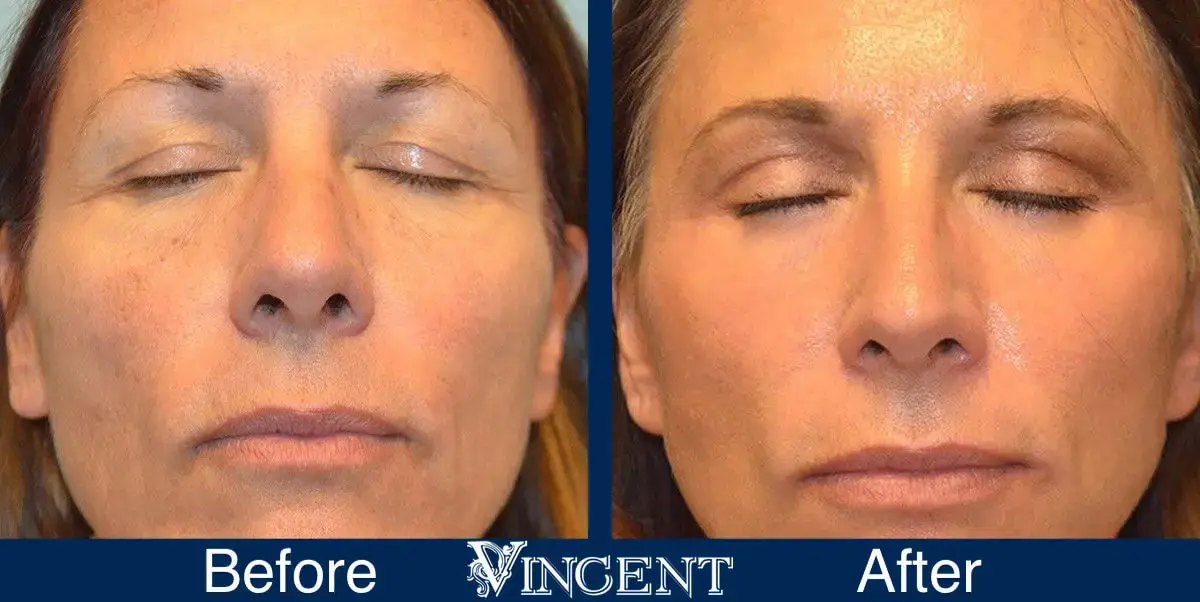 Vincent Surgical Arts blepharoplasty result — Cottonwood Heights, UT