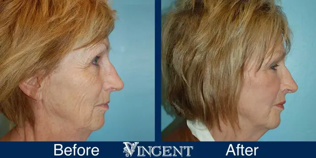 Fat Transfer result at Vincent Surgical Arts in Cottonwood Heights, UT