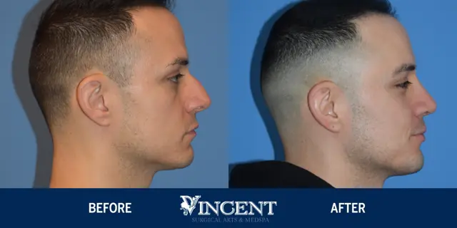 Rhinoplasty result at Vincent Surgical Arts in Cottonwood Heights, UT