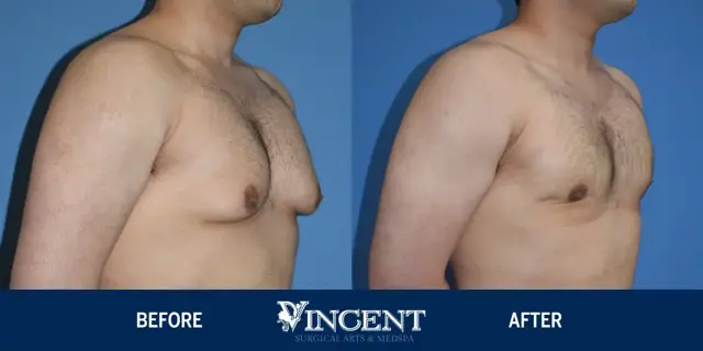 Gynecomastia Surgery result at Vincent Surgical Arts in Cottonwood Heights, UT