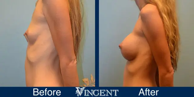 Breast Augmentation result at Vincent Surgical Arts in Cottonwood Heights, UT