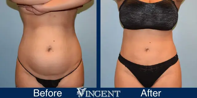 Liposuction result at Vincent Surgical Arts in Cottonwood Heights, UT