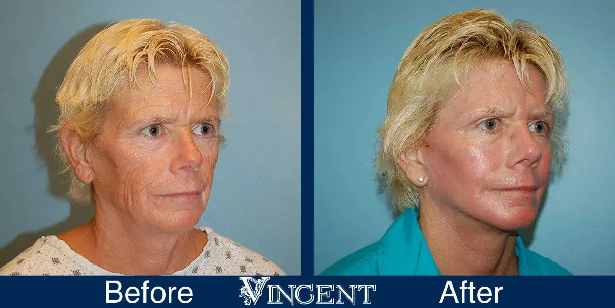 Vincent Surgical Arts fat transfer result — Cottonwood Heights, UT