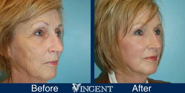 Fat Transfer result at Vincent Surgical Arts in Cottonwood Heights, UT