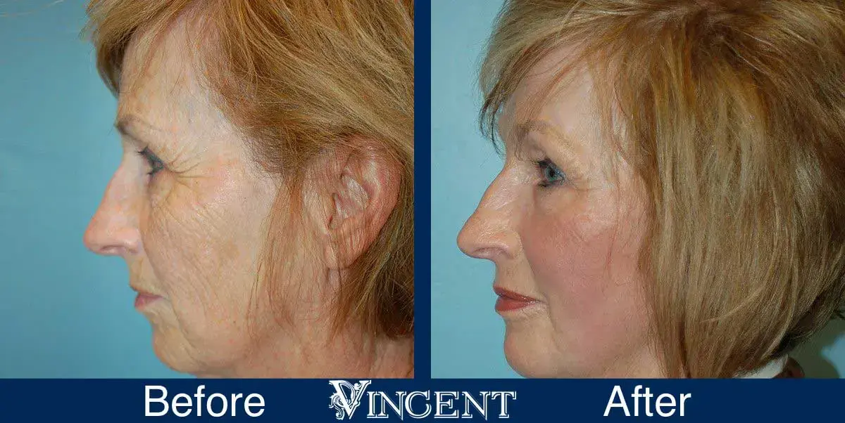 Vincent Surgical Arts fat transfer result — Cottonwood Heights, UT