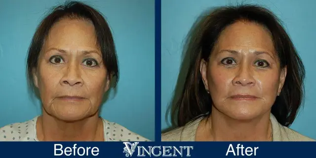 Facelift result at Vincent Surgical Arts in Cottonwood Heights, UT