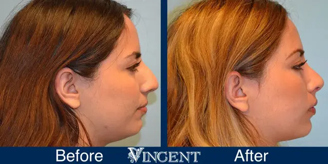 Rhinoplasty result at Vincent Surgical Arts in Cottonwood Heights, UT