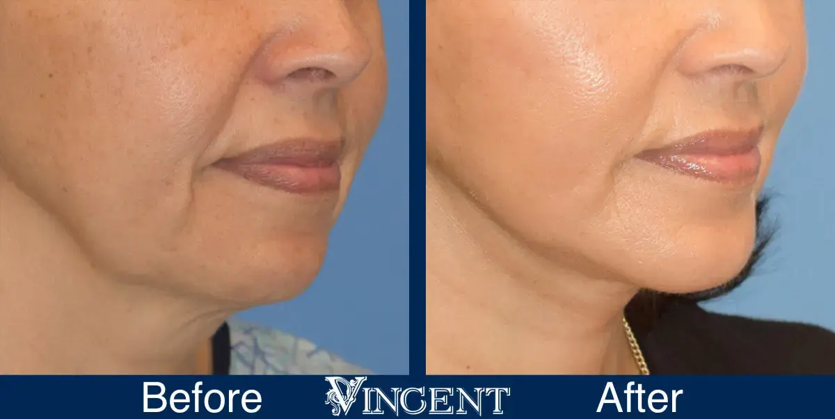 Vincent Surgical Arts chin implant result — Cottonwood Heights, UT